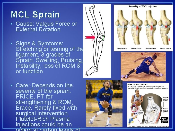 MCL Sprain • Cause: Valgus Force or External Rotation • Signs & Symtoms: Stretching