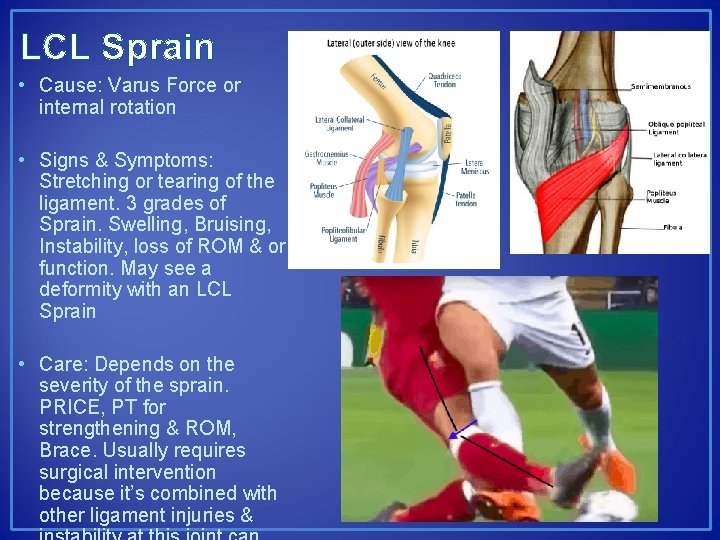 LCL Sprain • Cause: Varus Force or internal rotation • Signs & Symptoms: Stretching