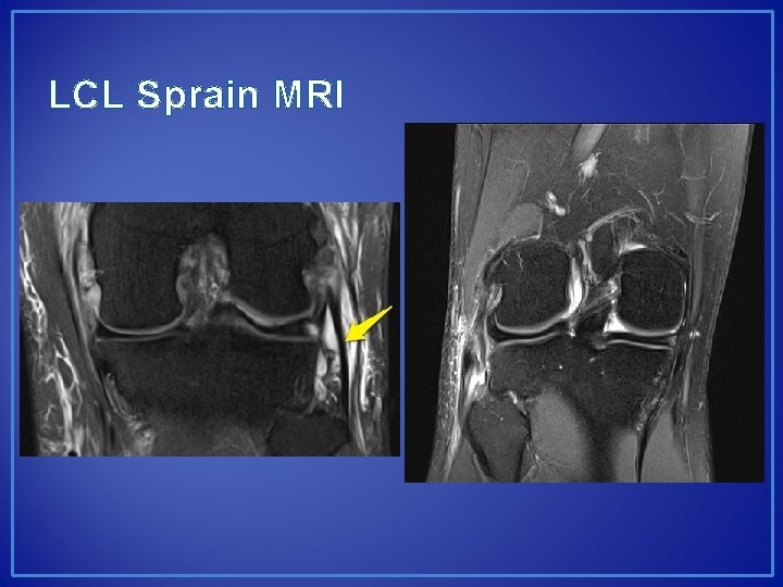 LCL Sprain MRI 