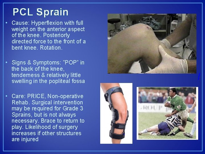 PCL Sprain • Cause: Hyperflexion with full weight on the anterior aspect of the