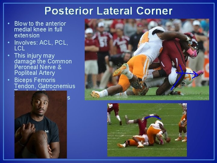 Posterior Lateral Corner • Blow to the anterior medial knee in full extension •