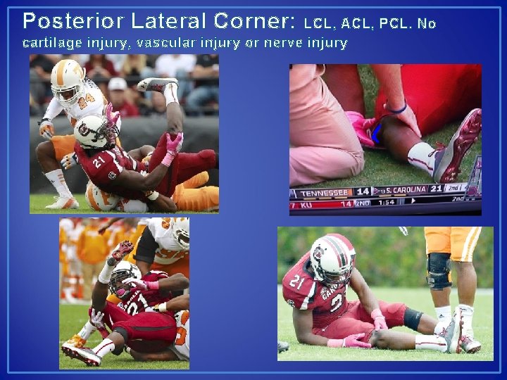 Posterior Lateral Corner: LCL, ACL, PCL. No cartilage injury, vascular injury or nerve injury