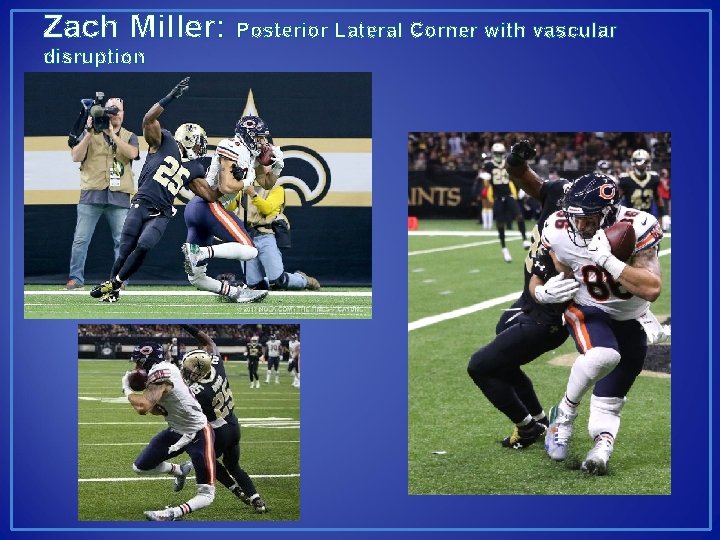 Zach Miller: disruption Posterior Lateral Corner with vascular 