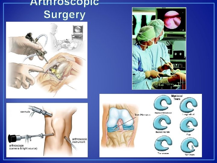 Arthroscopic Surgery 