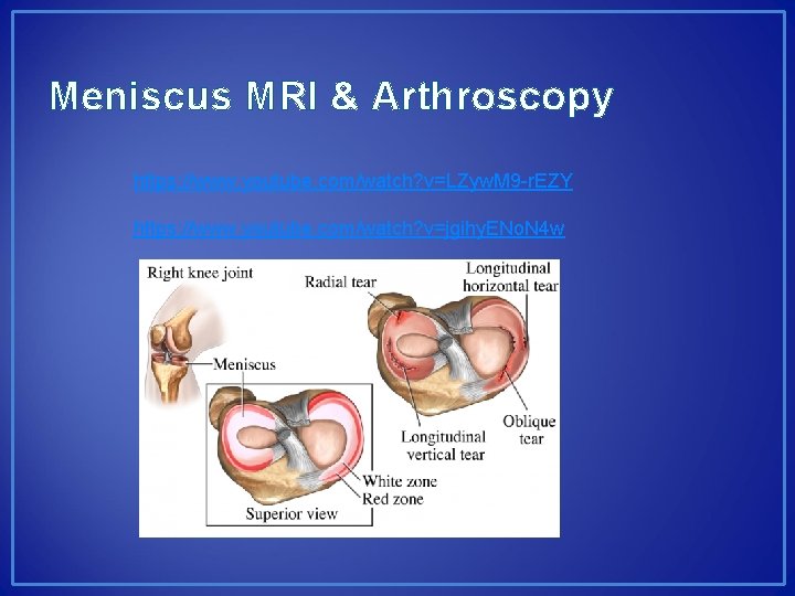Meniscus MRI & Arthroscopy https: //www. youtube. com/watch? v=LZyw. M 9 -r. EZY https: