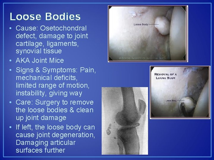 Loose Bodies • Cause: Osetochondral defect, damage to joint cartilage, ligaments, synovial tissue •