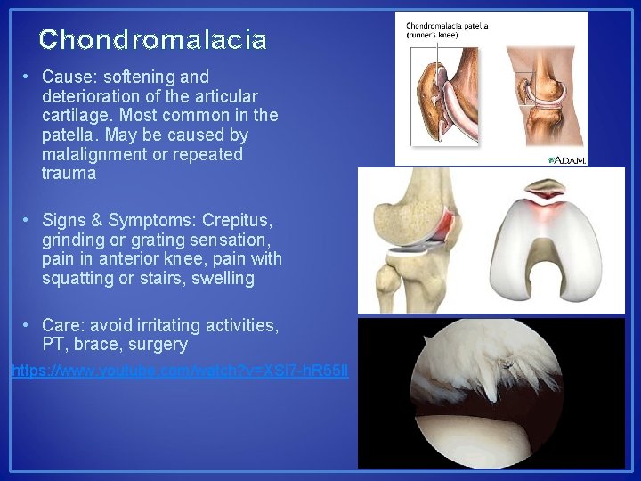 Chondromalacia • Cause: softening and deterioration of the articular cartilage. Most common in the