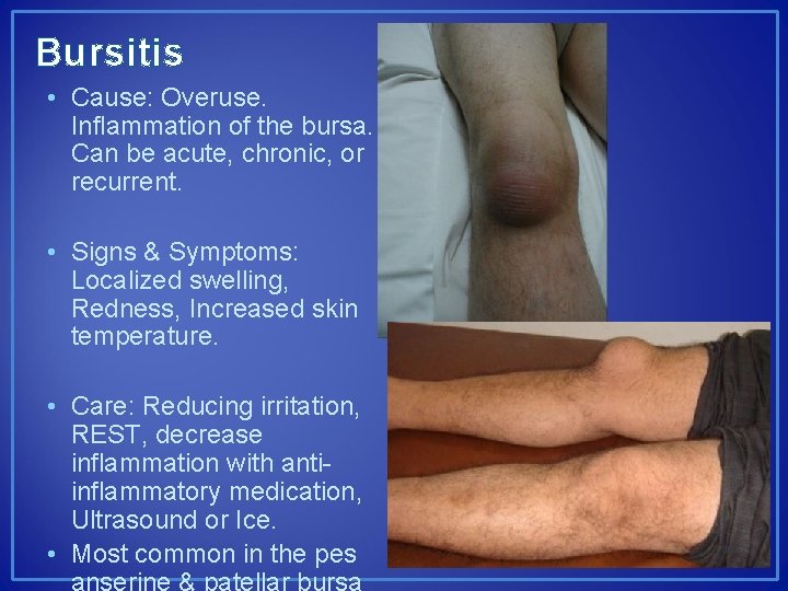 Bursitis • Cause: Overuse. Inflammation of the bursa. Can be acute, chronic, or recurrent.