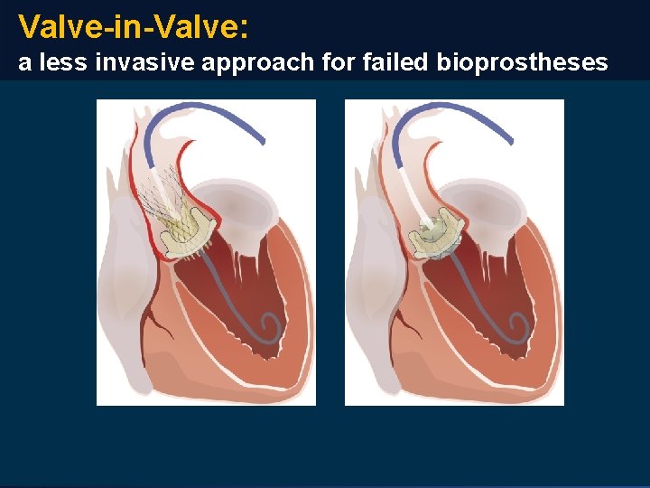Valve-in-Valve: a less invasive approach for failed bioprostheses 