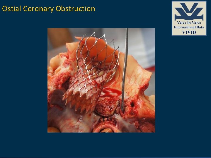Ostial Coronary Obstruction 