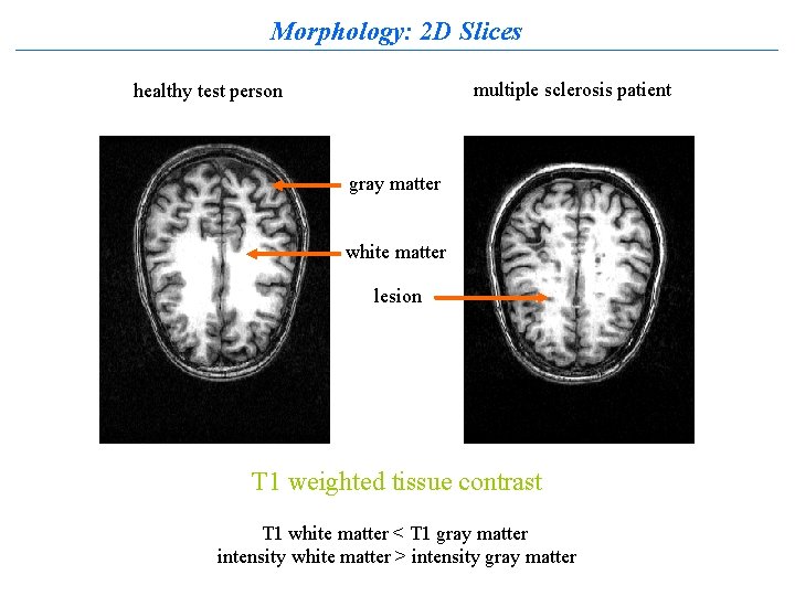 Morphology: 2 D Slices multiple sclerosis patient healthy test person gray matter white matter