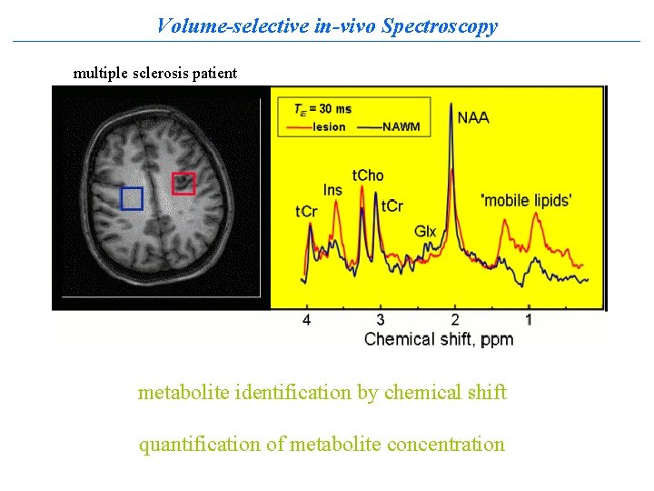 Volume-selective in-vivo Spectroscopy multiple sclerosis patient metabolite identification by chemical shift quantification of metabolite