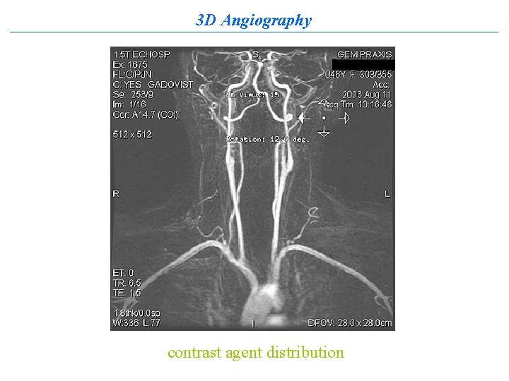3 D Angiography contrast agent distribution 