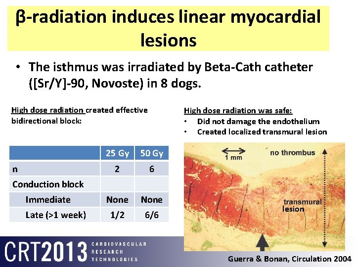 β-radiation induces linear myocardial lesions • The isthmus was irradiated by Beta-Cath catheter ([Sr/Y]-90,