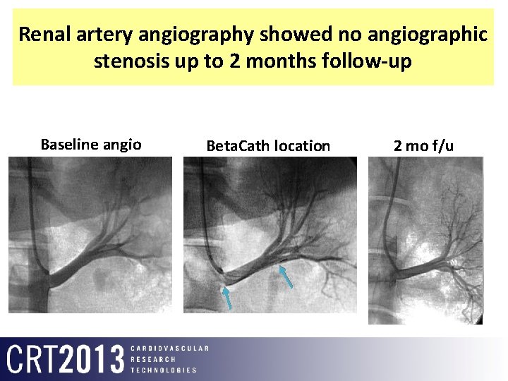 Renal artery angiography showed no angiographic stenosis up to 2 months follow-up Baseline angio