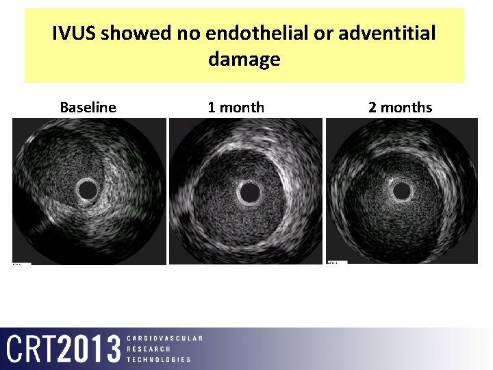 IVUS showed no endothelial or adventitial damage Baseline 1 month 2 months 