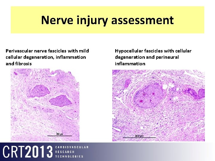 Nerve injury assessment Perivascular nerve fascicles with mild cellular degeneration, inflammation and fibrosis Hypocellular