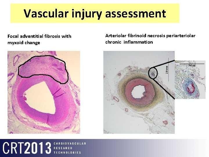 Vascular injury assessment Focal adventitial fibrosis with myxoid change Arteriolar fibrinoid necrosis periarteriolar chronic
