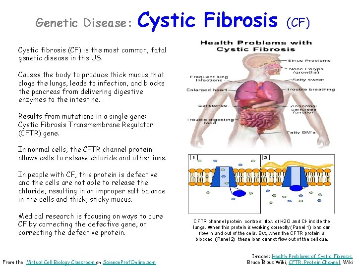 Genetic Disease: Cystic Fibrosis (CF) Cystic fibrosis (CF) is the most common, fatal genetic