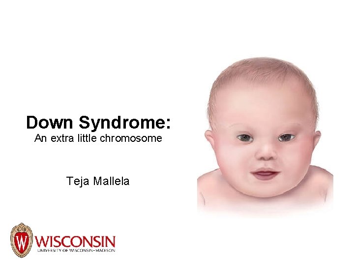Down Syndrome: An extra little chromosome Teja Mallela 