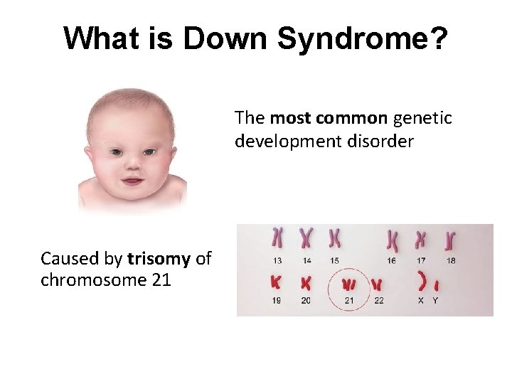 What is Down Syndrome? The most common genetic development disorder Caused by trisomy of