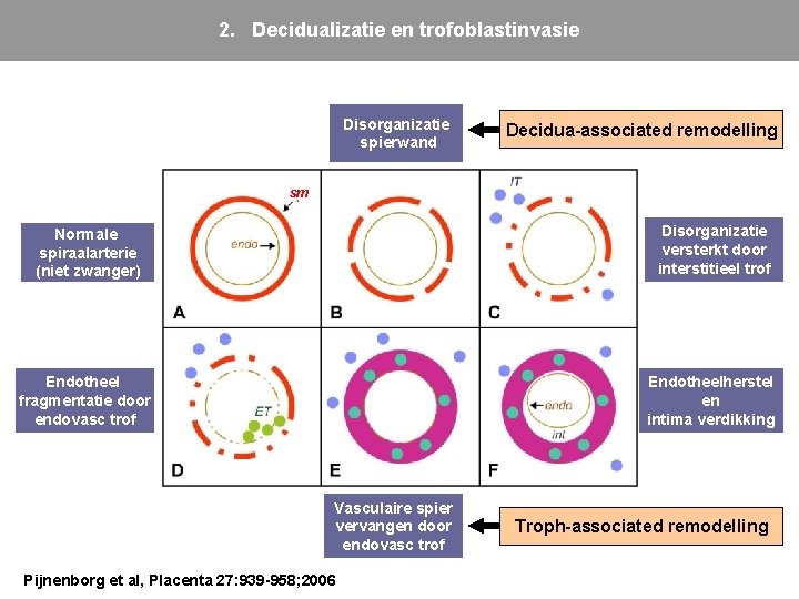 2. Decidualizatie en trofoblastinvasie Disorganizatie spierwand Decidua-associated remodelling sm Normale spiraalarterie (niet zwanger) Disorganizatie