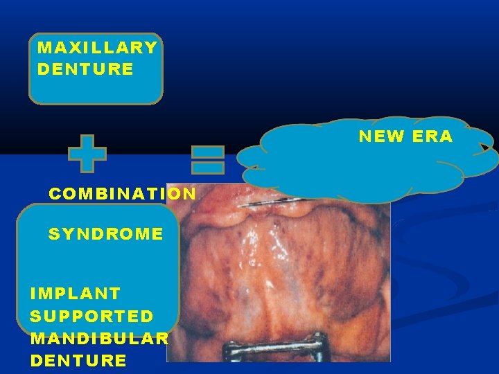 MAXILLARY DENTURE NEW ERA COMBINATION SYNDROME IMPLANT SUPPORTED MANDIBULAR DENTURE 