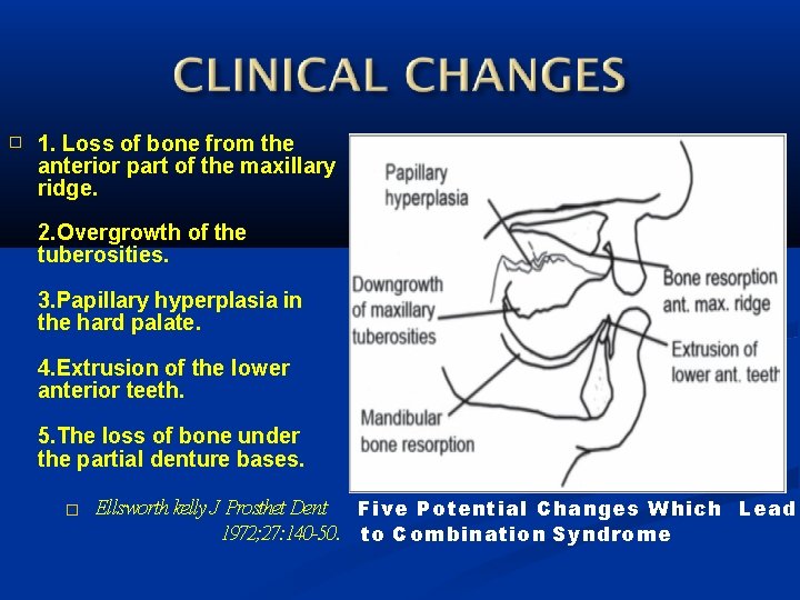 � 1. Loss of bone from the anterior part of the maxillary ridge. 2.