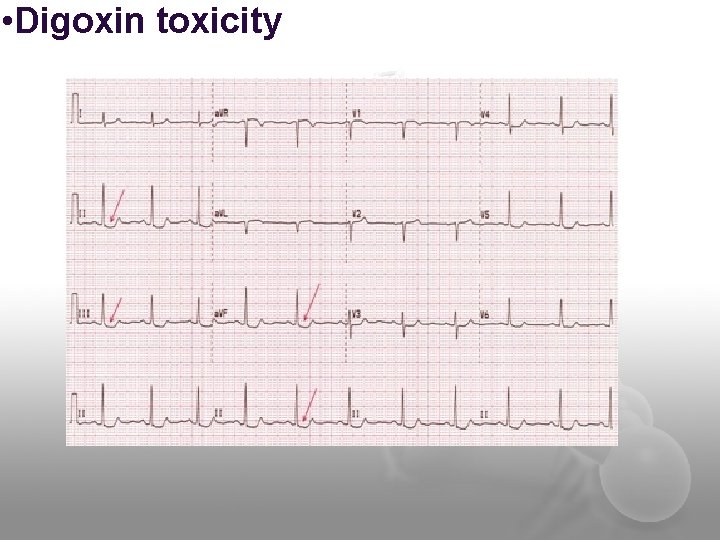  • Digoxin toxicity 