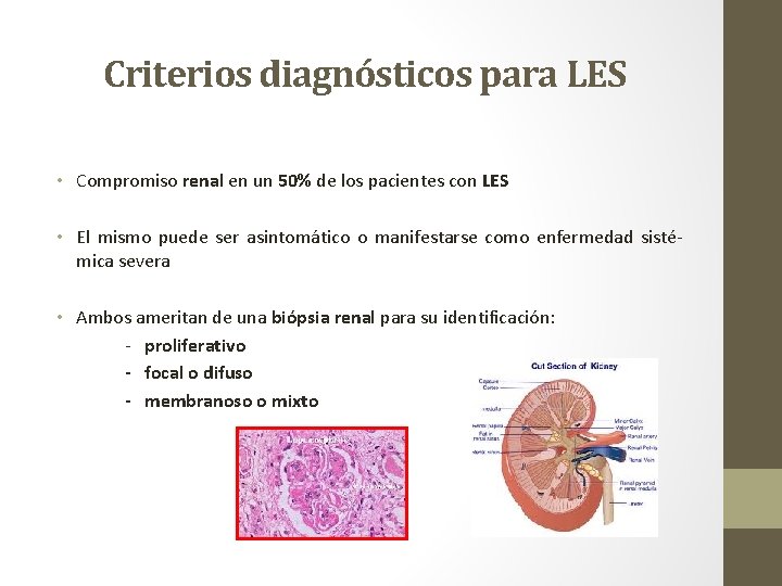 Criterios diagnósticos para LES • Compromiso renal en un 50% de los pacientes con