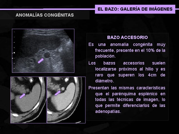 EL BAZO: GALERÍA DE IMÁGENES ANOMALÍAS CONGÉNITAS BAZO ACCESORIO Es una anomalía congénita muy