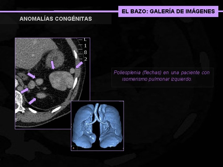 EL BAZO: GALERÍA DE IMÁGENES ANOMALÍAS CONGÉNITAS Poliesplenia (flechas) en una paciente con isomerismo