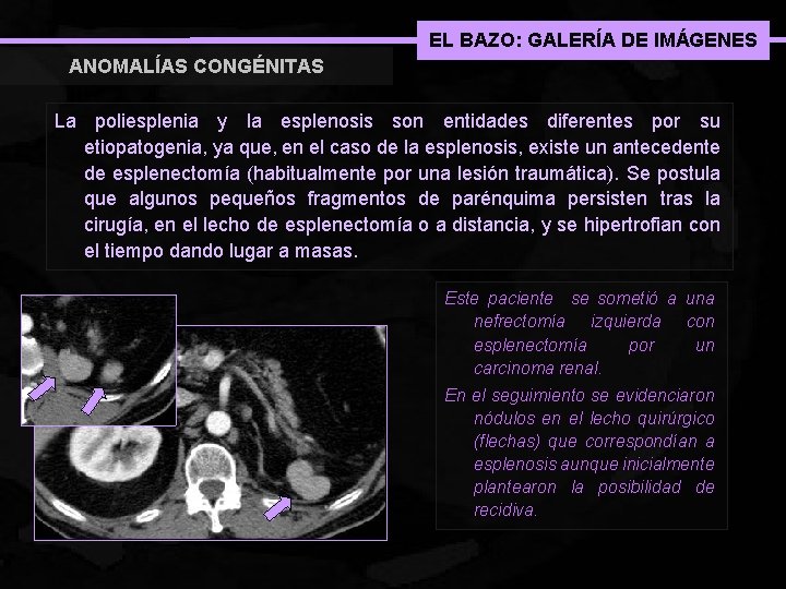 EL BAZO: GALERÍA DE IMÁGENES ANOMALÍAS CONGÉNITAS La poliesplenia y la esplenosis son entidades