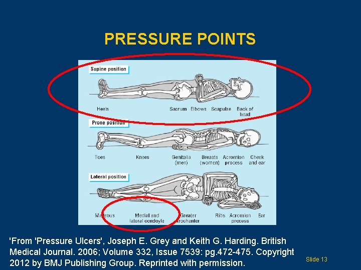 PRESSURE POINTS 'From 'Pressure Ulcers', Joseph E. Grey and Keith G. Harding. British Medical