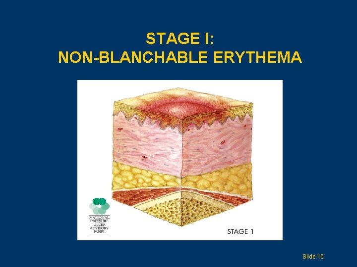 STAGE I: NON-BLANCHABLE ERYTHEMA Slide 15 