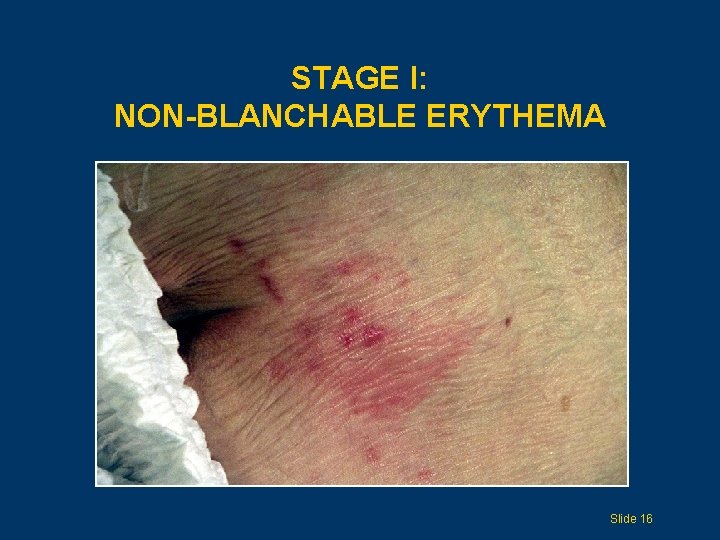 STAGE I: NON-BLANCHABLE ERYTHEMA Slide 16 