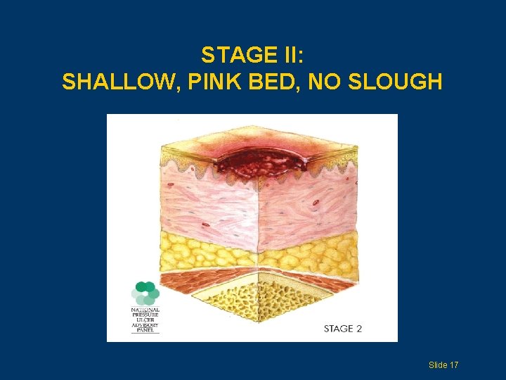STAGE II: SHALLOW, PINK BED, NO SLOUGH Slide 17 