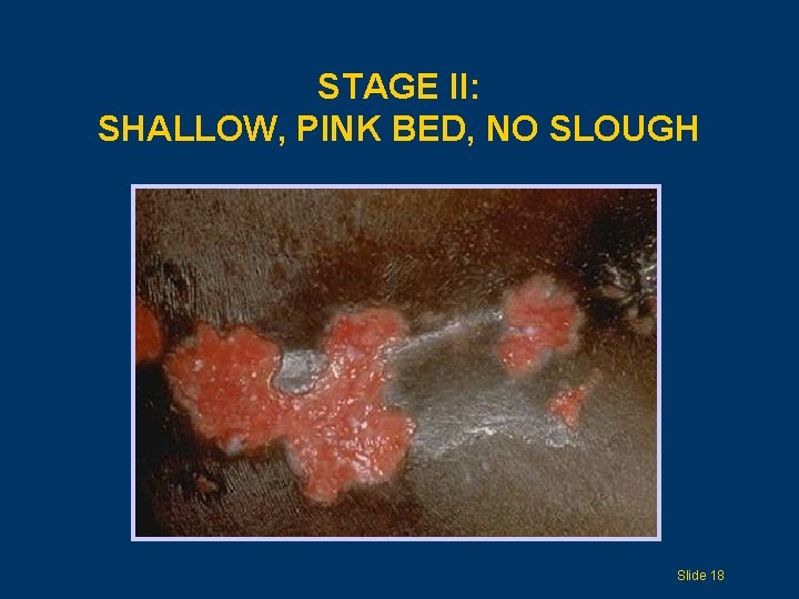 STAGE II: SHALLOW, PINK BED, NO SLOUGH Slide 18 
