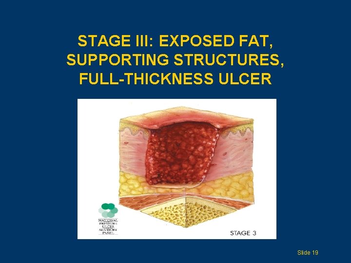 STAGE III: EXPOSED FAT, SUPPORTING STRUCTURES, FULL-THICKNESS ULCER Slide 19 