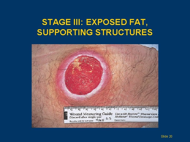 STAGE III: EXPOSED FAT, SUPPORTING STRUCTURES Slide 20 