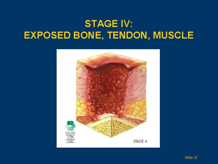 STAGE IV: EXPOSED BONE, TENDON, MUSCLE Slide 21 