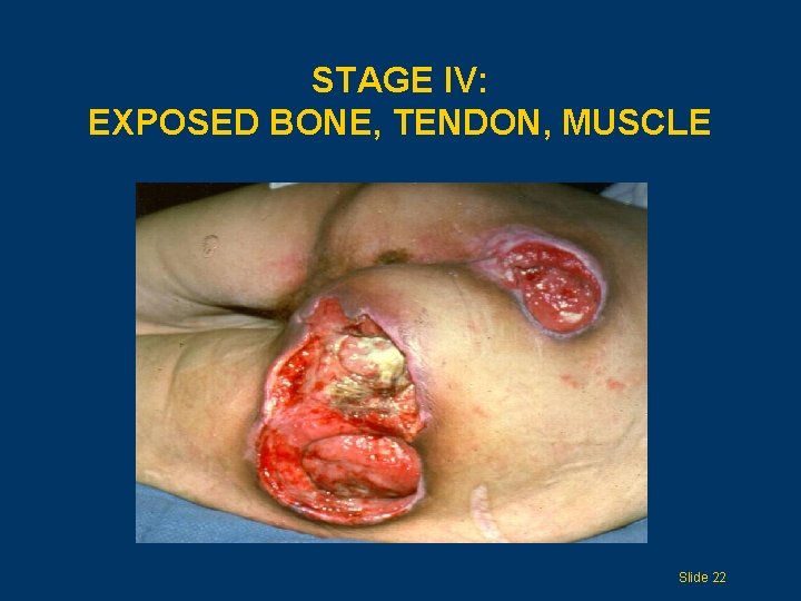 STAGE IV: EXPOSED BONE, TENDON, MUSCLE Slide 22 