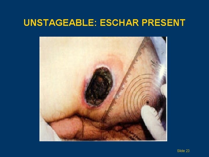 UNSTAGEABLE: ESCHAR PRESENT Slide 23 