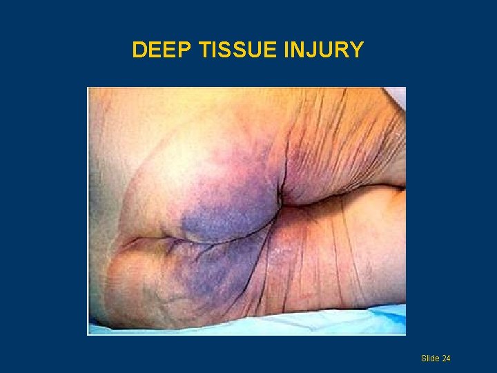 DEEP TISSUE INJURY Slide 24 