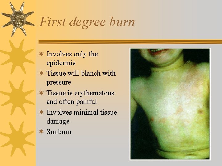 First degree burn ¬ Involves only the epidermis ¬ Tissue will blanch with pressure