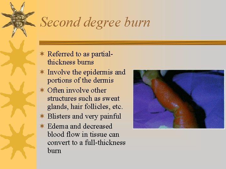 Second degree burn ¬ Referred to as partialthickness burns ¬ Involve the epidermis and