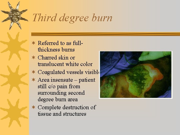 Third degree burn ¬ Referred to as fullthickness burns ¬ Charred skin or translucent
