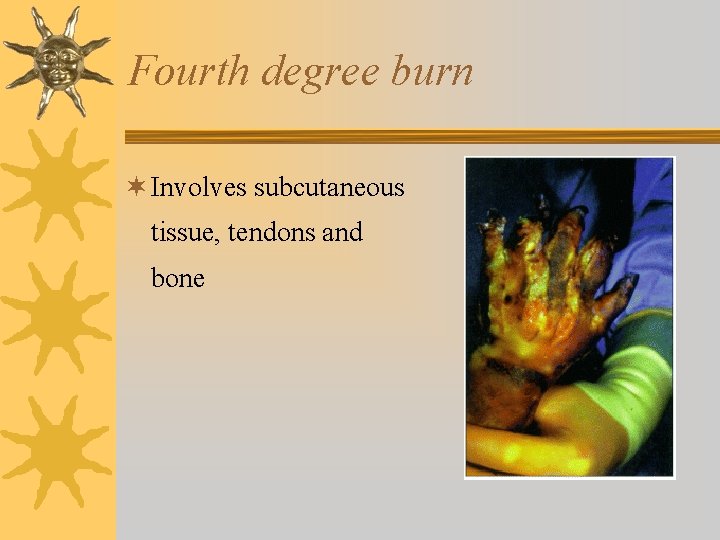 Fourth degree burn ¬ Involves subcutaneous tissue, tendons and bone 