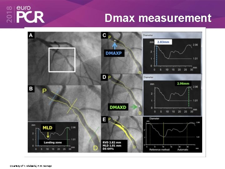 Dmax measurement Courtesy of Y. Ishibashi, P. W. Serruys 