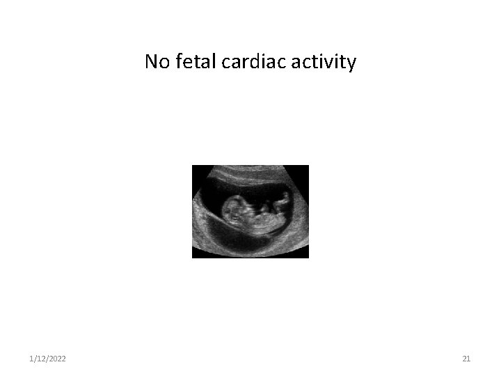 No fetal cardiac activity 1/12/2022 21 